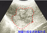 脾臓の超音波検査所見