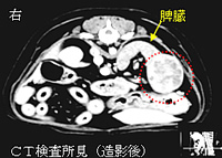 CT検査所見（造影後）